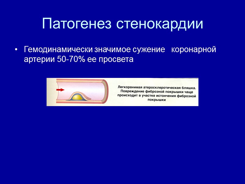 Патогенез стенокардии Гемодинамически значимое сужение   коронарной артерии 50-70% ее просвета